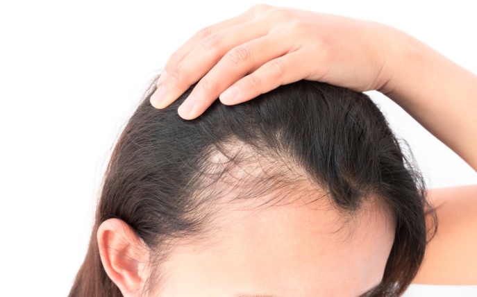 Low Immunity causing hair loss